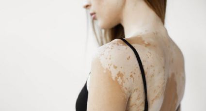 ¿Qué es el vitiligo? causas, síntomas y tratamiento