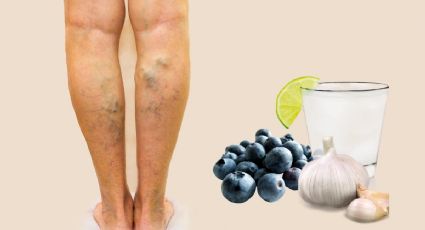 ¿Cómo reducir las varices de forma natural?