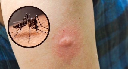 ¿Cómo calmar la picazón de las picaduras de mosquitos con remedios caseros?