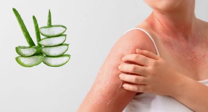 ¿Cómo aplicar aloe vera en la piel quemada por el sol?