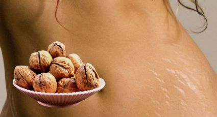 5 alimentos para prevenir y reducir la aparición de estrías en la piel