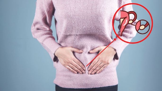 Síntomas de que puedes tener síndrome de ovario poliquístico