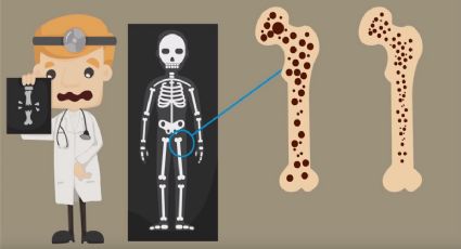 5 claves para prevenir la osteoporosis