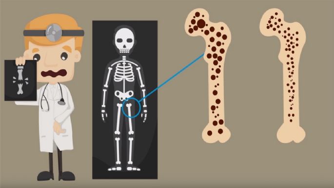 5 claves para prevenir la osteoporosis