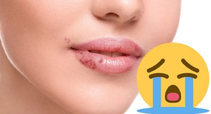 ¿Cómo quitar los fuegos labiales? 3 tips para conseguirlo