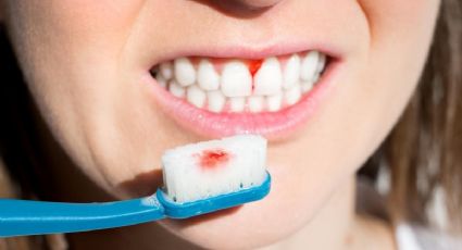 ¿Tienes gingivitis? Estas son su causas y síntomas