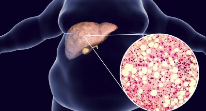 Hígado graso: ¿qué es y cómo prevenirlo?