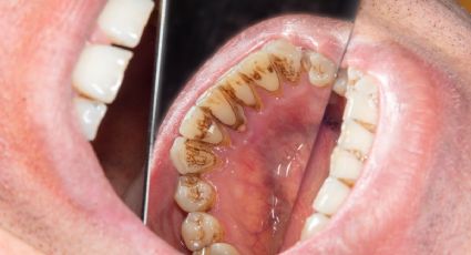 ¿Por qué el sarro en los dientes se hace negro?