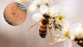 ¿Qué pasa si no me quito el aguijón de una abeja?