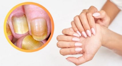 ¿Cómo quitar lo amarillo de las uñas de las manos?