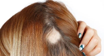 Caída del cabello en forma circular: síntomas, causas y tratamiento de la alopecia areata