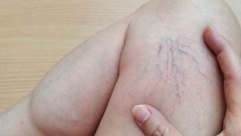 Arañitas en las piernas: por qué salen y su diferencia con las varices