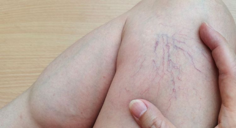 Arañitas en las piernas: por qué salen y su diferencia con las varices