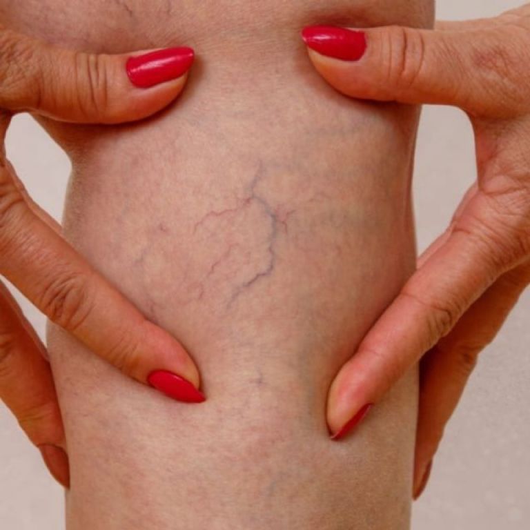 Por qué aparecen las arañitas en las piernas