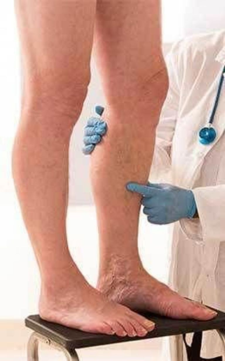 Qué tengo que hacer si me salen arañitas en las piernas