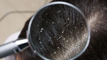 Caspa en el cuero cabelludo: por qué sale y cómo eliminarla del cabello