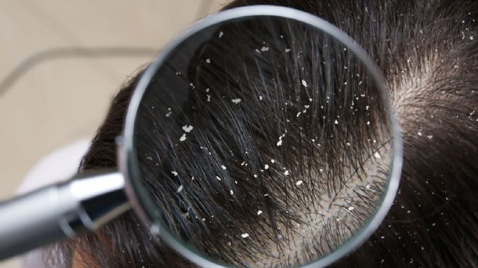Caspa en el cuero cabelludo: por qué sale y cómo eliminarla del cabello
