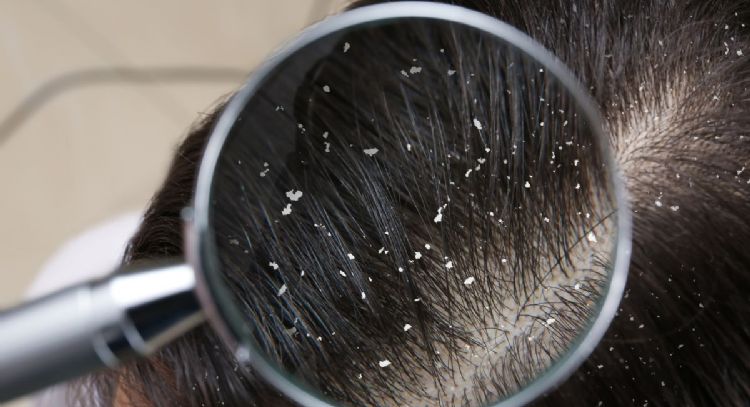 Caspa en el cuero cabelludo: por qué sale y cómo eliminarla del cabello