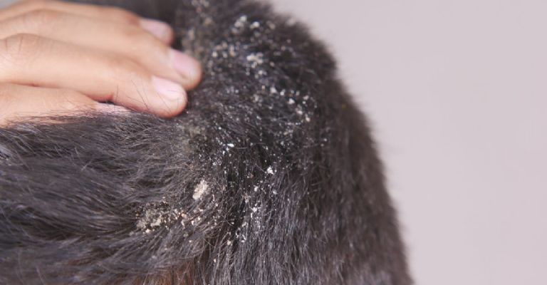 ¿Qué causa la caspa en el cabello?